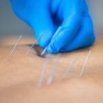 Dry Needling: A Modern Approach to Pain Relief